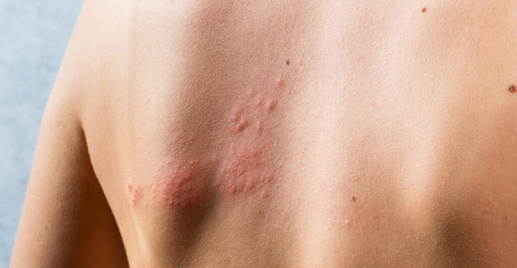 Herpes Zoster: o que é e como o tratamento fotossônico pode ajudar 3 Costas com sintomas da Herpes Zoster